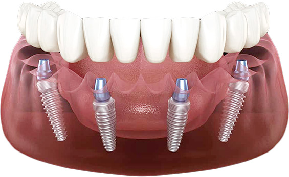 Treatment Concept Dental Implants