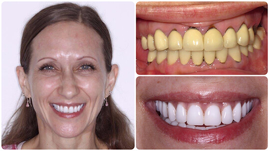Success Story Teeth-in-1-Day